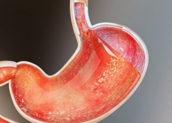 Stomach cancer Oren Zarif