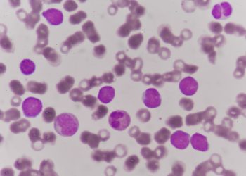 Acute Myeloid Leukemia