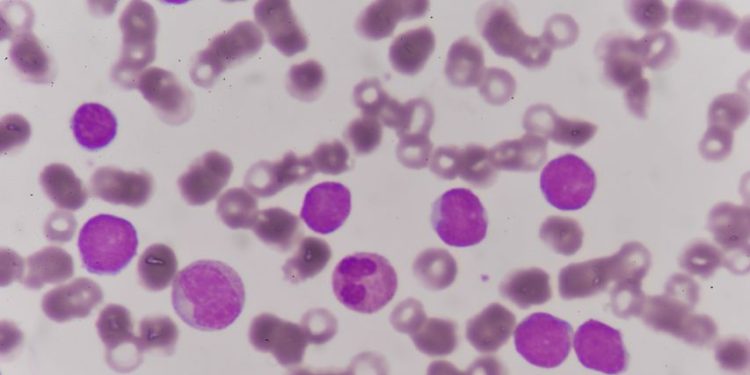 Acute Myeloid Leukemia