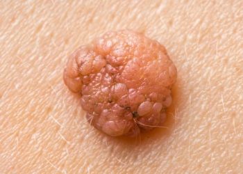 Squamous Cell Carcinoma