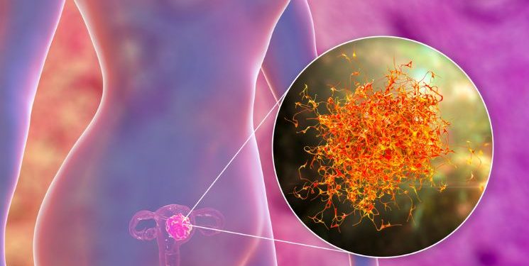 Uterine Cancer Treatment