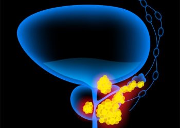 How to Treat Penile Cancer