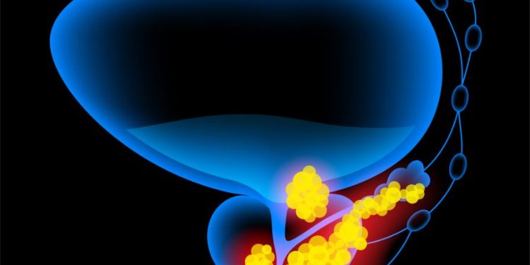 How to Treat Penile Cancer