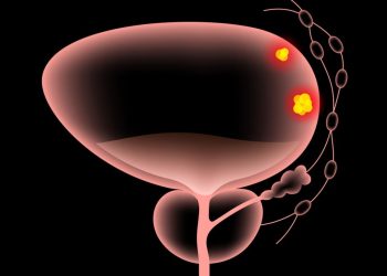 Bladder Cancer Symptoms