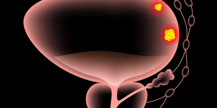 Bladder Cancer Symptoms