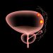 Bladder Cancer Symptoms