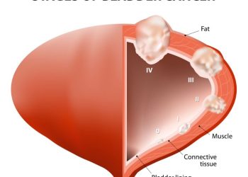 Bladder Cancer – Symptoms and Treatment