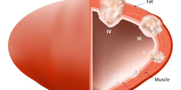 Bladder Cancer – Symptoms and Treatment