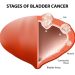 Bladder Cancer – Symptoms and Treatment