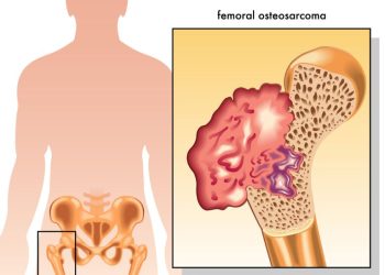 Osteosarcoma
