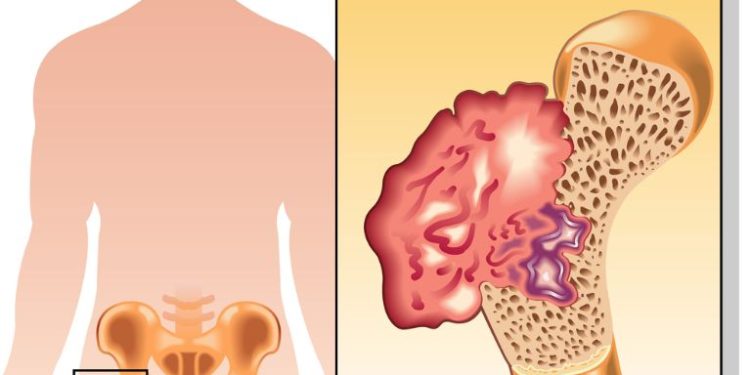 Osteosarcoma