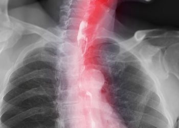 Esophageal Cancer and Damaged DNA