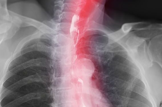 Esophageal Cancer and Damaged DNA