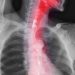 Esophageal Cancer and Damaged DNA