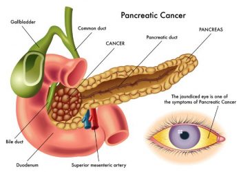 What Happens If You Have Pancreatic Cancer?