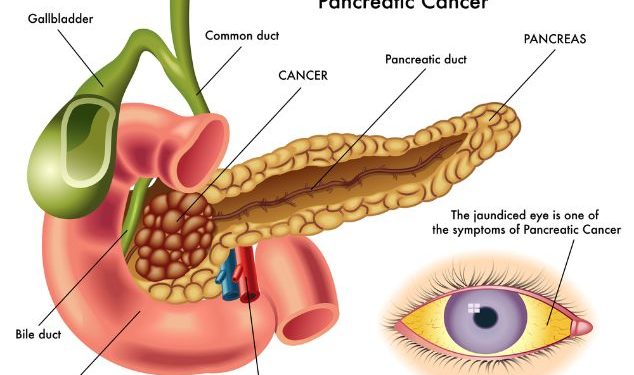 What Happens If You Have Pancreatic Cancer?