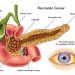 What Happens If You Have Pancreatic Cancer?