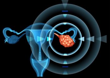 What is an Ovarian Cyst?