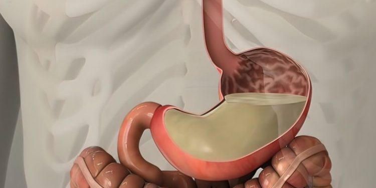 Oren Zarif treatment for stomach cancer