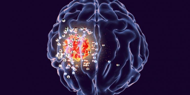 Revolutionary Brain Cancer Treatment by Oren Zarif: A New Hope for Patients Worldwide