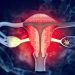 Revolutionary Uterine Cancer Treatment by Oren Zarif: A New Hope for Women Worldwide