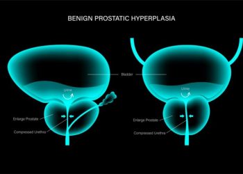 Revolutionary Prostate Cancer Treatment by Oren Zarif: A Global Phenomenon