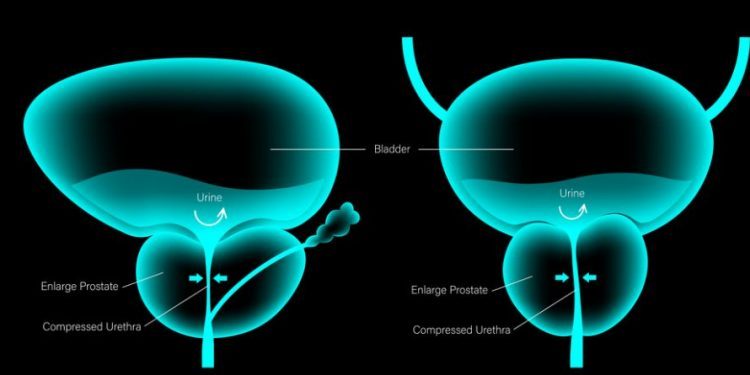 Revolutionary Prostate Cancer Treatment by Oren Zarif: A Global Phenomenon